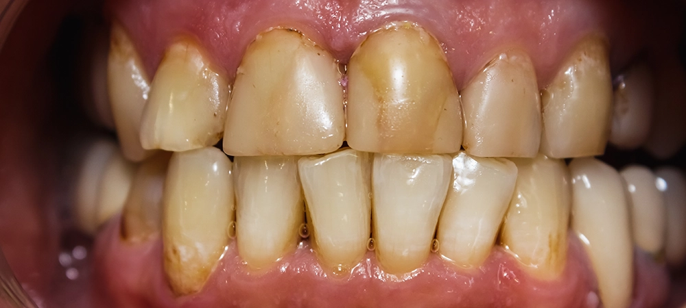 oral health complications