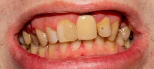 poor oral health
