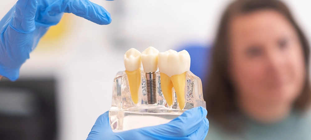 the advantages of dental implants