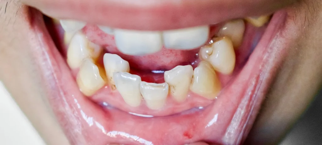 misaligned teeth