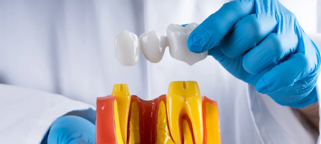 understanding the cost of dental bridge