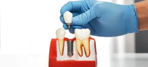 dental implants or dentures